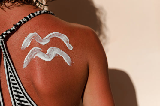 Sunburns? Beat the Heat with These Natural Remedies