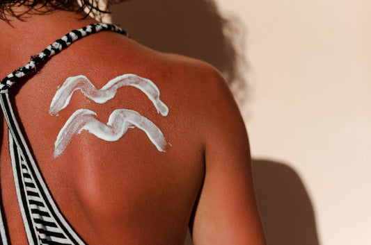 Sunburns? Beat the Heat with These Natural Remedies